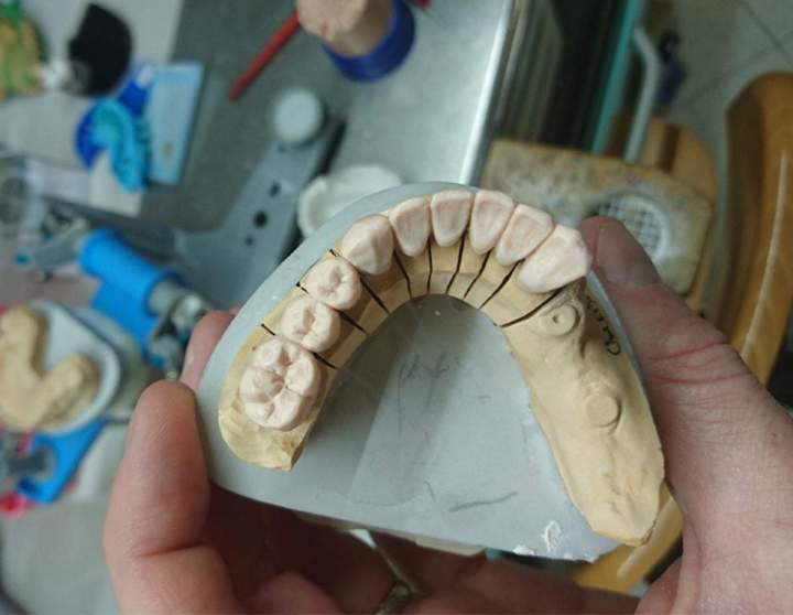 Fabrication de prothèse dentaire Normandie