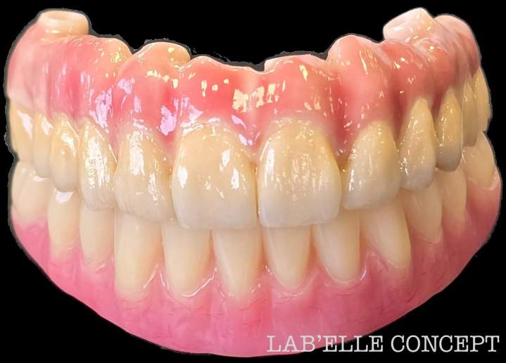 Réalisation de prothèses dentaires sur implants complètes et adaptées à chaque patient