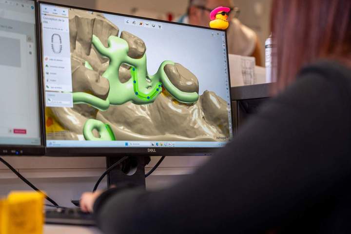 Fabrication d'orthèses pour l'apnée du sommeil TALI