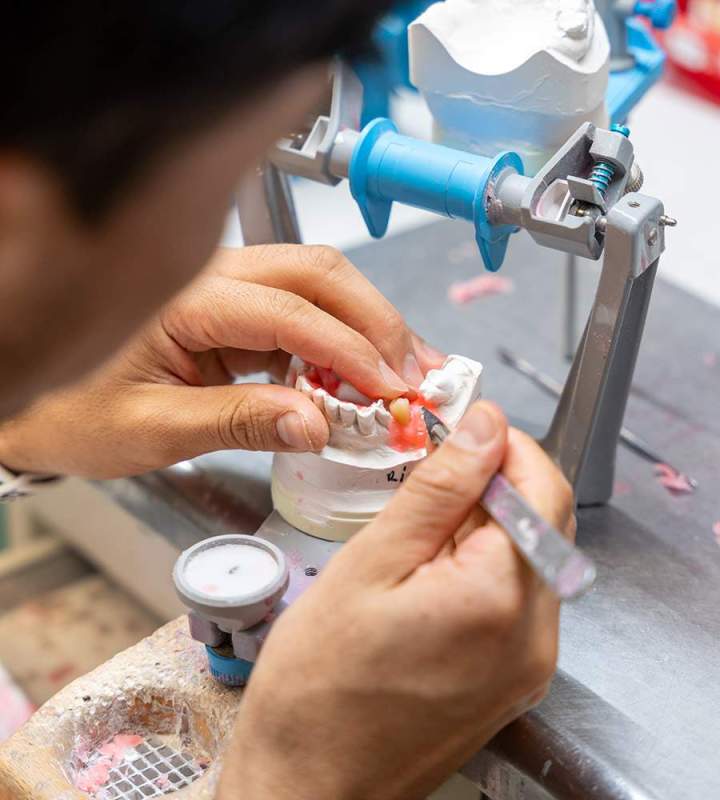 Fabrication sur mesure de prothèses All on 4 Normandie