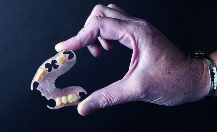 Fabrication prothèse All on 4, Rouen