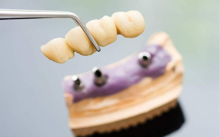 Fabricant de prothèse All on 4 Normandie