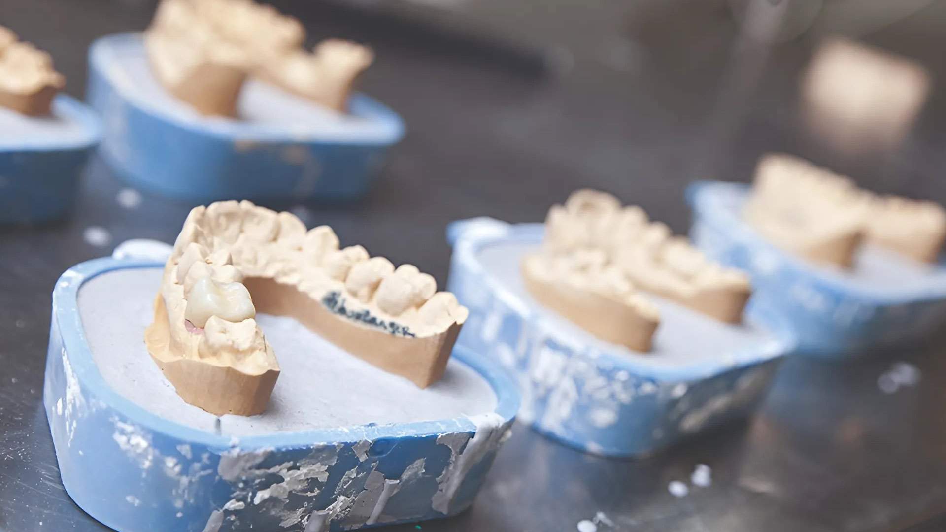 Fabrication numérique de prothèse dentaire Normandie